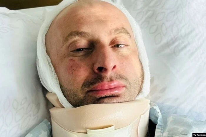 Zastraszenie protestu w Gruzji: dziennikarz trafił do szpitala z złamaniami kości twarzowej